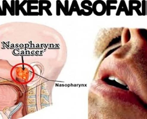 Definisi Lengkap Tentang Kanker Nasofaring